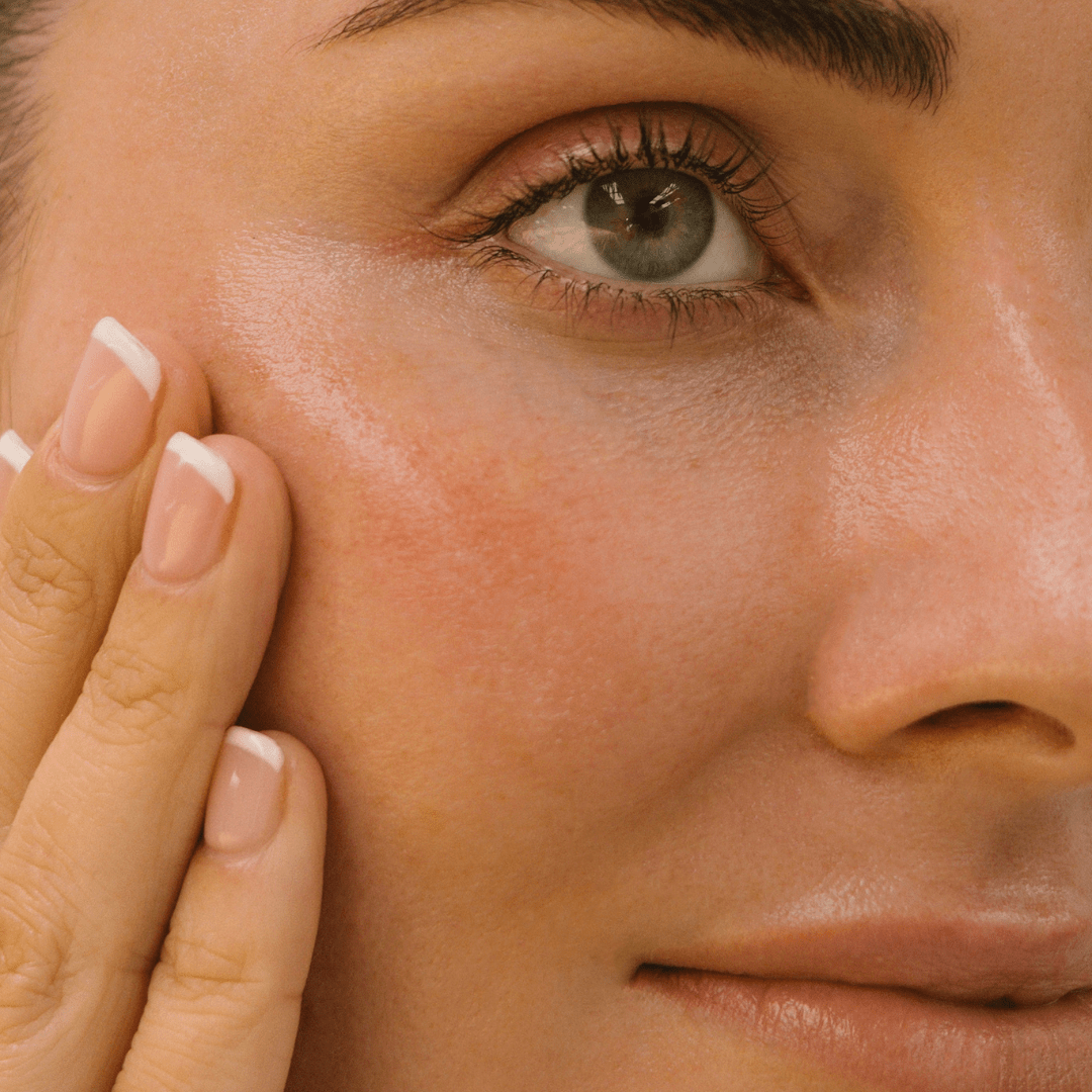 What’s Your Problem? Acne