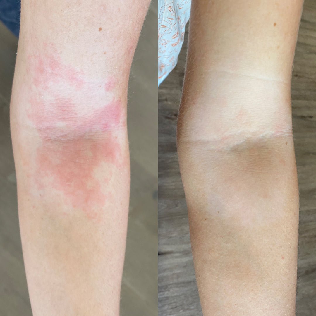 Moisturiser for eczema and inflamed skin before and after