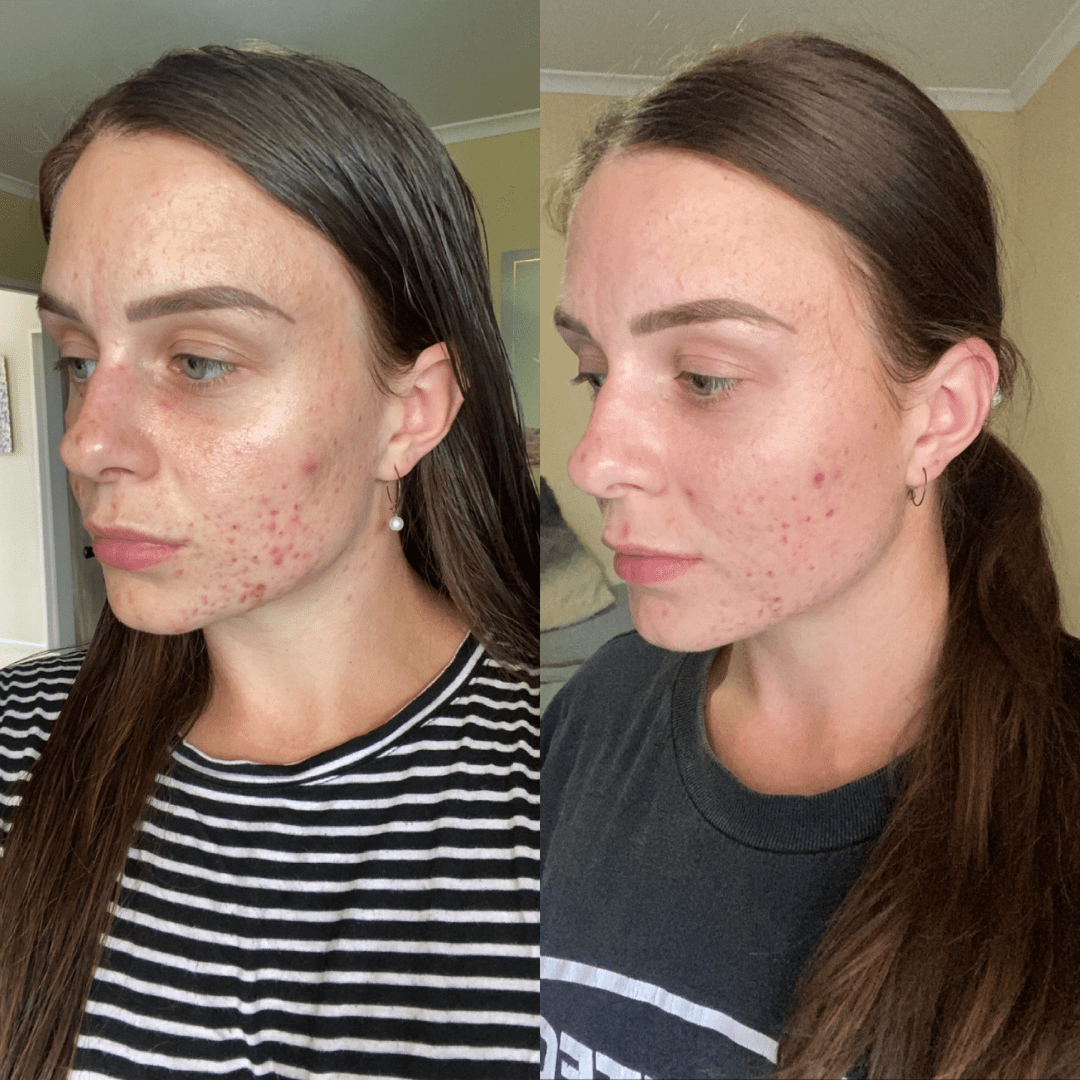 Before after results of Eco by Sonya Clear Skin System on acne