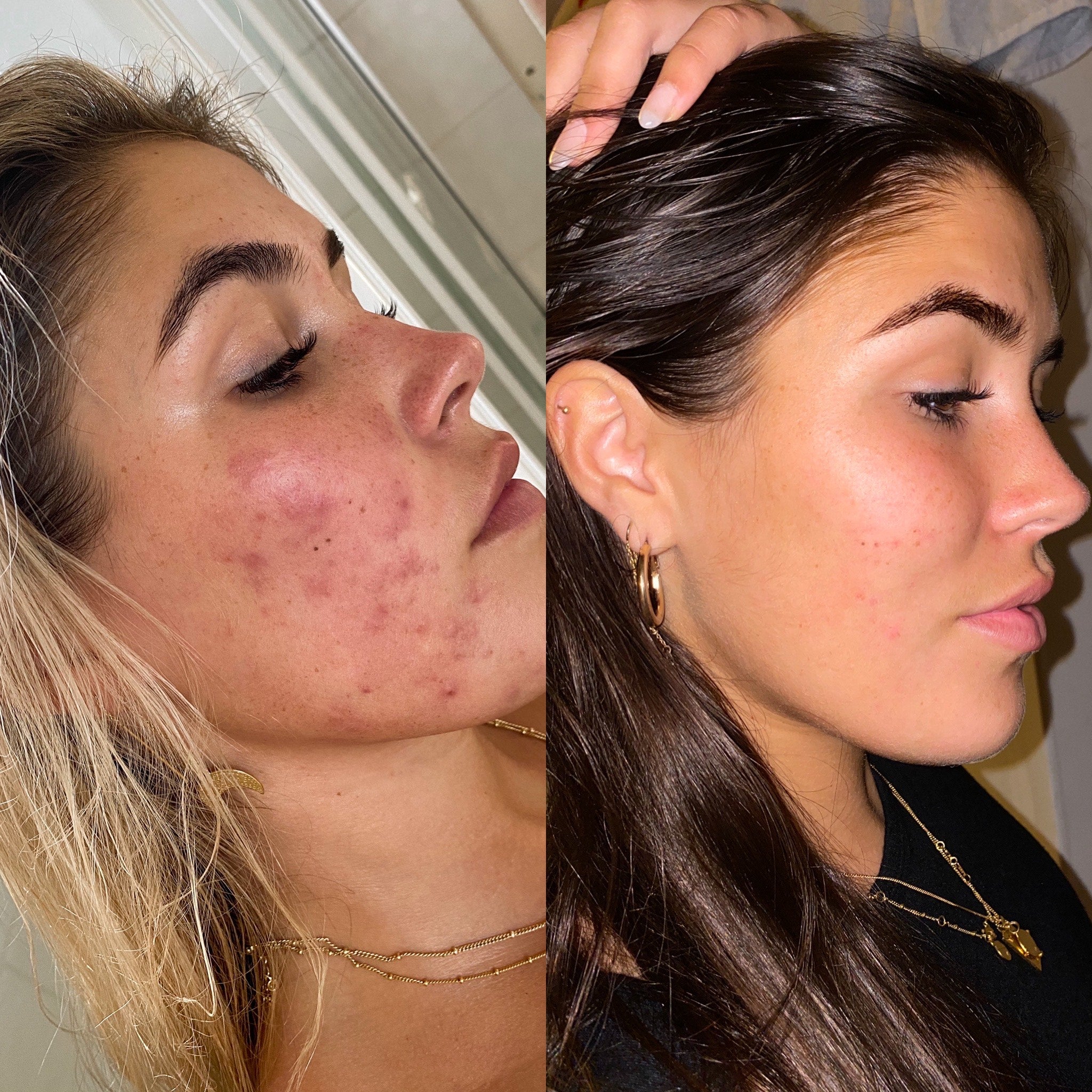 Clear Skin System before after results for acne, redness, texture, blackheads